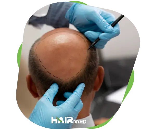 How to Obtain Follicular Unit to be Used for Hair Transplantation