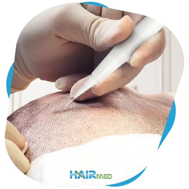 DHI Hair Transplant Method